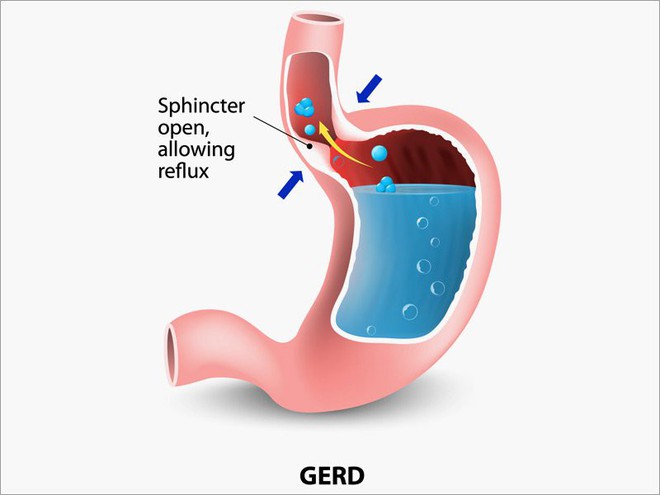 Hôi miệng khi ngủ dậy: Nếu không phải vì thức ăn, đây là 3 bệnh nguy hiểm cần chữa ngay - Ảnh 3.