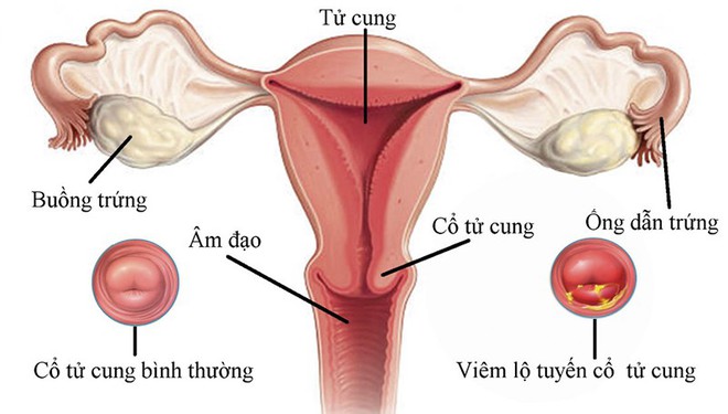 Lạm dụng thuốc tránh thai khẩn cấp: Nhiều tác hại khôn lường, thậm chí có thể gây ung thư - Ảnh 3.