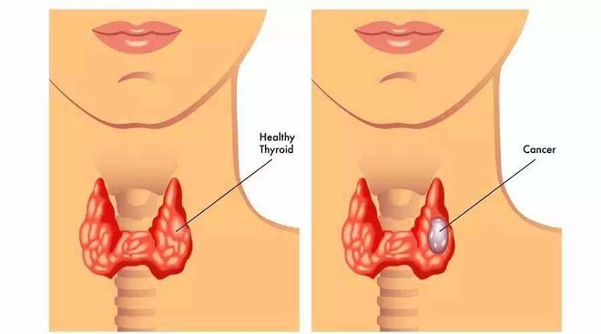 5 loại bệnh vặt không lo chữa, để quá lâu sẽ có nguy cơ tiến triển thành ung thư - Ảnh 4.