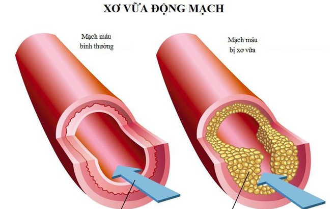 Tẩy sạch mạch máu để ngăn ngừa đột quỵ dựa vào công thức "3 cao, 4 thấp" nổi tiếng Đông y