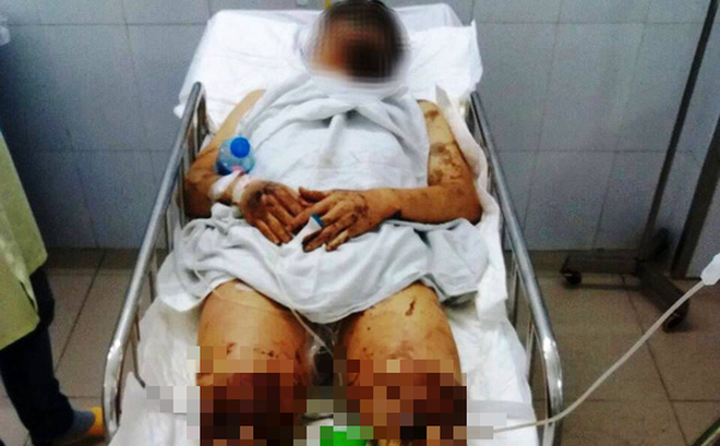 Nhận dạng nghi phạm tạt axit, cắt đứt gân chân nam Việt kiều: Người gầy, nói giọng Bắc