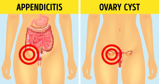 6 căn bệnh thường bị nhầm lẫn với bệnh khác: Chậm trễ điều trị có thể gây nguy hiểm - Ảnh 5.
