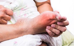 30 tuổi trở đi, nếu có dấu hiệu này cần phải cảnh giác ngay với bệnh gút 30 tuổi trở đi, nếu có dấu hiệu này cần phải cảnh giác ngay với bệnh gút