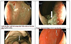 Loét dạ dày không điều trị có thể thành ung thư: Chuyên gia mách cách sống chung với bệnh Loét dạ dày không điều trị có thể thành ung thư: Chuyên gia mách cách sống chung với bệnh