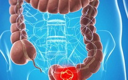 Triệu chứng phổ biến của polyp đại trực tràng, nếu phát hiện nên khám để hạn chế biến chứng Triệu chứng phổ biến của polyp đại trực tràng, nếu phát hiện nên khám để hạn chế biến chứng