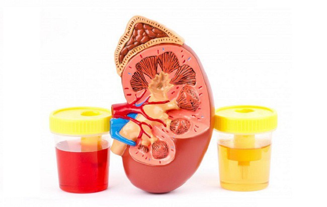 Nước tiểu thay đổi màu, đau lưng dưới... bác sĩ khuyên nên đi khám ngay kẻo ung thư