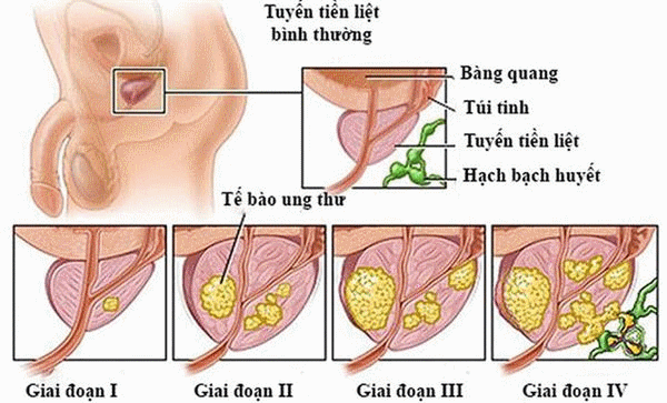 Ung thư tuyến tiền liệt không còn đáng sợ - Ảnh 1.