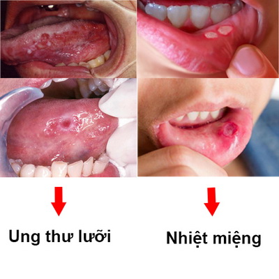 Phân biệt nhiệt miệng và ung thư lưỡi - Ảnh 1.