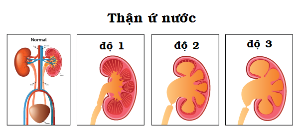 Cách phát hiện sớm thận ứ nước - Ảnh 1.