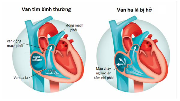 Hở van tim có dễ phát hiện?