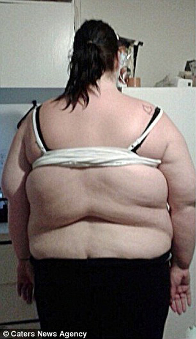 Bụng to như trống, người phụ nữ giảm liền 105kg trong vòng 1 tháng, nhìn vòng 2 sau giảm cân khiến nhiều người khiếp sợ không dám giảm cân cấp tốc nữa - Ảnh 2.