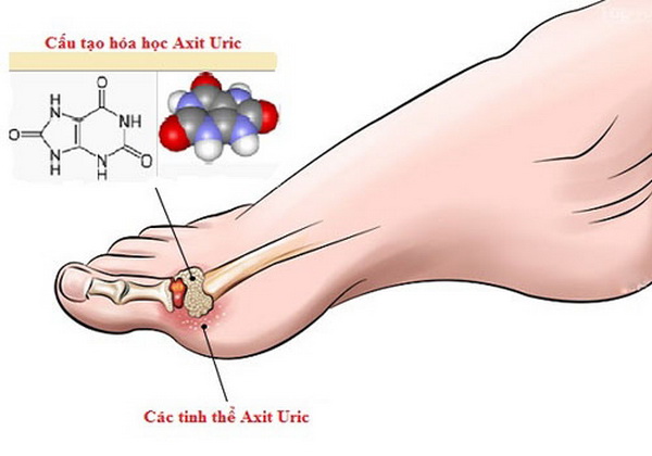 Xử trí tăng acid uric máu - Ảnh 1.