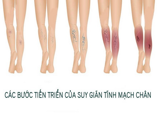 Suy giãn tĩnh mạch chân - âm thầm nhưng đau đớn - Ảnh 1.