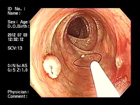 Chuyên gia tiêu hóa chỉ ra dấu hiệu của bệnh đại tràng không nên bỏ qua - Ảnh 2.