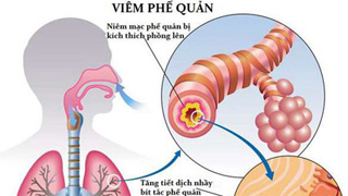 6 bệnh viêm phổi - phế quản thường gặp - Ảnh 1.