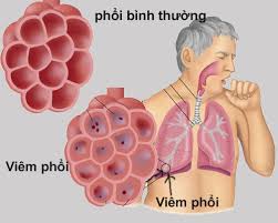 6 bệnh viêm phổi - phế quản thường gặp - Ảnh 2.