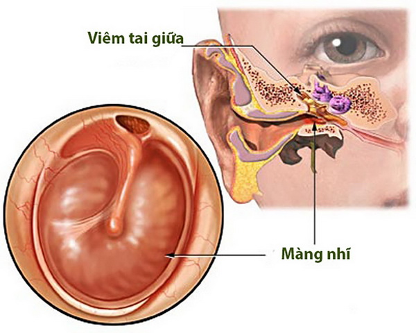 Bài thuốc trị viêm tai giữa - Ảnh 1.