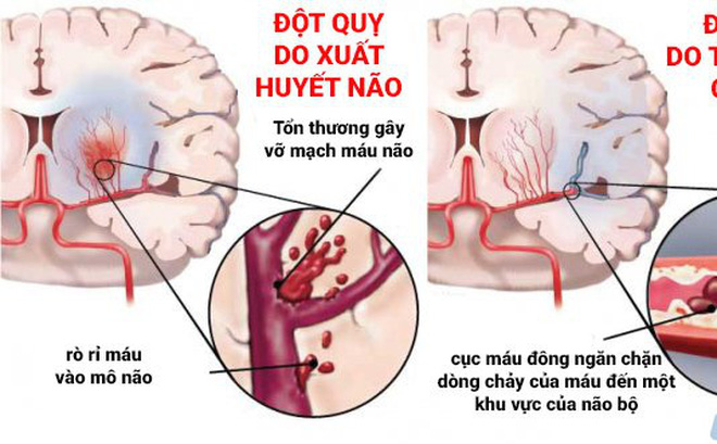 Đột quỵ não ở Việt Nam đang ở mức báo động đỏ: Chuyên gia gửi 5 câu hỏi để người trẻ kiểm tra lối sống - Ảnh 1. Đột quỵ não ở Việt Nam đang ở mức báo động đỏ: Chuyên gia gửi 5 câu hỏi để người trẻ kiểm tra lối sống - Ảnh 1.