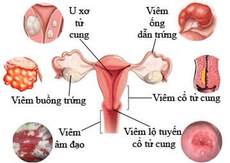 Bệnh phụ khoa – “Kẻ thù” của sức khỏe và sinh sản - Ảnh 2.