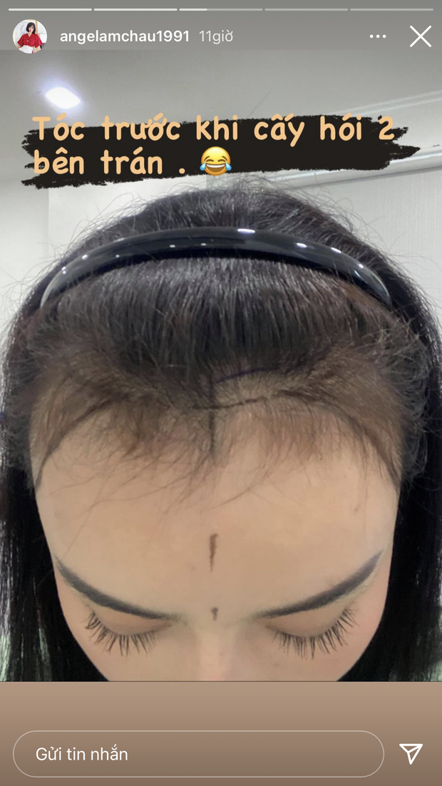 Hiện tượng dao kéo Việt tiết lộ đã cấy 2.000 sợi tóc, nối dài danh sách tu sửa để mãi đẹp - Ảnh 3.