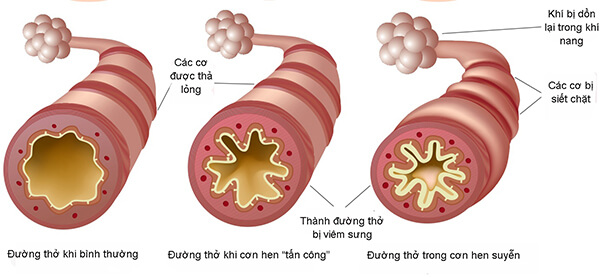 10 yếu tố khiến hen phế quản nặng lên - Ảnh 1.