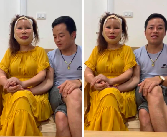 Vừa hoàn tất ca phẫu thuật thẩm mỹ không lâu, cô dâu 62 tuổi nay lại nắm tay chồng xuất hiện với gương mặt sưng phồng, băng bó khắp mặt - Ảnh 3.