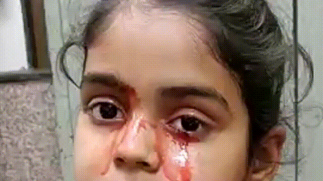 Giải mã bí ẩn của haemolacria: Chứng bệnh khiến những cô gái Ấn Độ khóc ra máu - Ảnh 1.