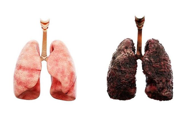 Tại sao không hút thuốc lá vẫn mắc ung thư phổi? Hóa ra đó là một dạng ung thư khác - Ảnh 1.