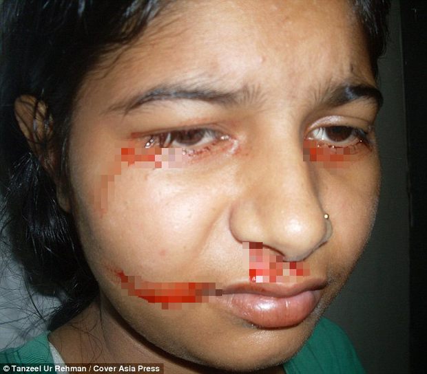 Giải mã bí ẩn của haemolacria: Chứng bệnh khiến những cô gái Ấn Độ khóc ra máu - Ảnh 3.