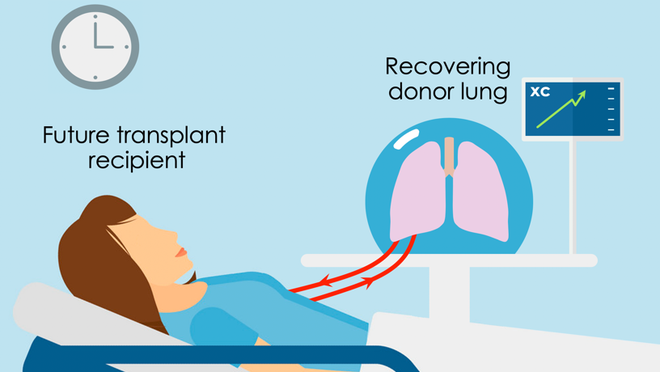 Đột phá: Phổi người tổn thương được chữa lành sau 24 giờ nối vào cơ thể lợn - Ảnh 5.