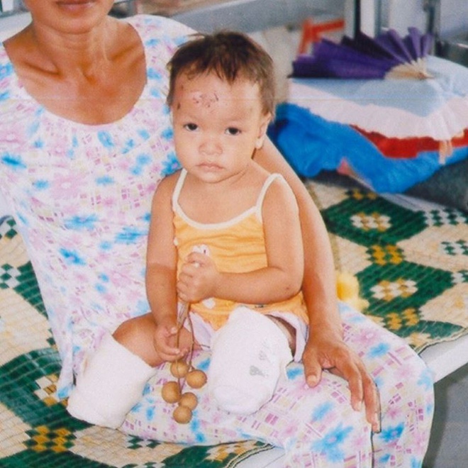 Sau 17 năm được nhận nuôi ở Mỹ, cuộc sống hiện tại của bé gái Việt mất 2 chân sau vụ nổ thương tâm khiến ai cũng phải ngạc nhiên - Ảnh 1.