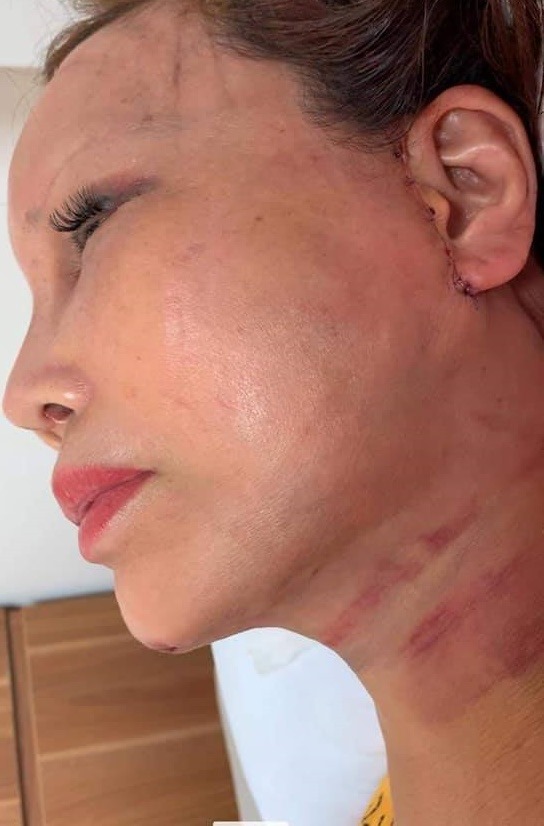 Cô dâu 63 tuổi ở Cao Bằng khoe vết sẹo chạy dọc phần tai sau 1 tháng phẫu thuật căng da mặt khiến nhiều người bủn rủn - Ảnh 2.