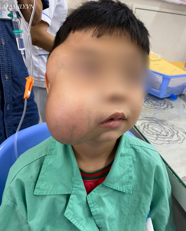 Bé trai 13 tuổi mang khối u xơ vòm họng khổng lồ lần đầu tiên ghi nhận tại Việt Nam - Ảnh 2.