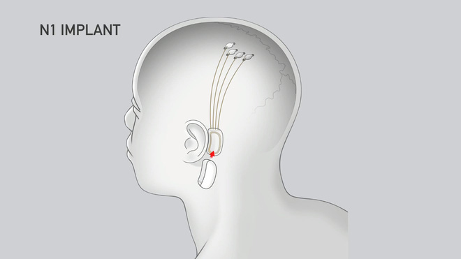 Neuralink và tham vọng cộng sinh với trí tuệ nhân tạo của Elon Musk - Ảnh 6.