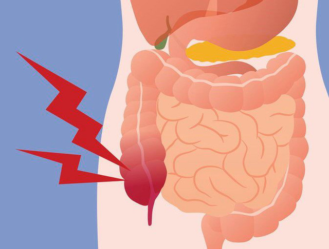 Bệnh lý viêm ruột thừa, sợ nhất hai từ “quá muộn”: Bác sĩ BV Việt Đức lưu ý những phản xạ cần có khi đau bụng để bảo toàn tính mạng - Ảnh 2.