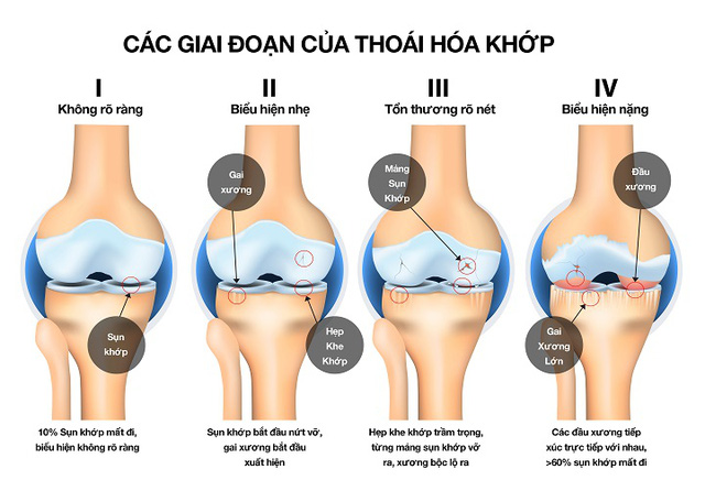 Bác sĩ BV Việt Đức cảnh báo căn bệnh hơn 23% người trung niên ở Việt Nam đều mắc, không điều trị sớm có thể sinh thêm trầm cảm - Ảnh 4.