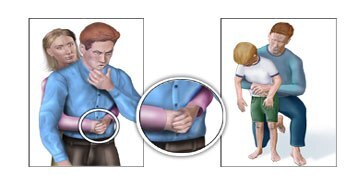 Lại một trẻ tử vong vì hóc thạch: Cơ hội duy nhất chỉ 4-5 phút, bố mẹ cần làm gì cứu con? - Ảnh 2. Lại một trẻ tử vong vì hóc thạch: Cơ hội duy nhất chỉ 4-5 phút, bố mẹ cần làm gì cứu con? - Ảnh 2.