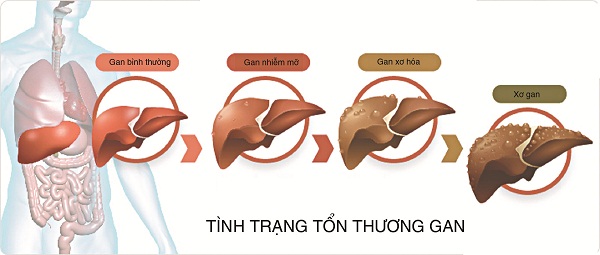 Tác hại của mỡ máu cao - Ảnh 3.