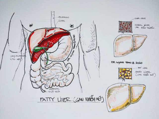 Bác sĩ Việt tại Mỹ chỉ ra thủ phạm gây bệnh gan nhiễm mỡ dù không uống rượu bia, cách ngăn ngừa tốt nhất là điều chỉnh một điều này - Ảnh 1.