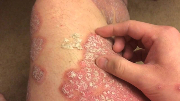 Nhiều bệnh về da dễ bùng phát trong mùa lạnh - Ảnh 2.