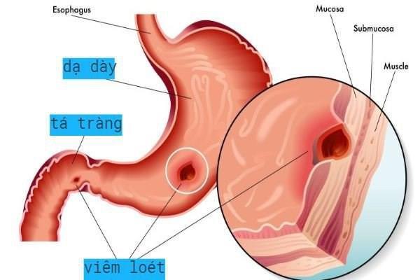 5 quy tắc cho người bị viêm dạ dày - Ảnh 1.