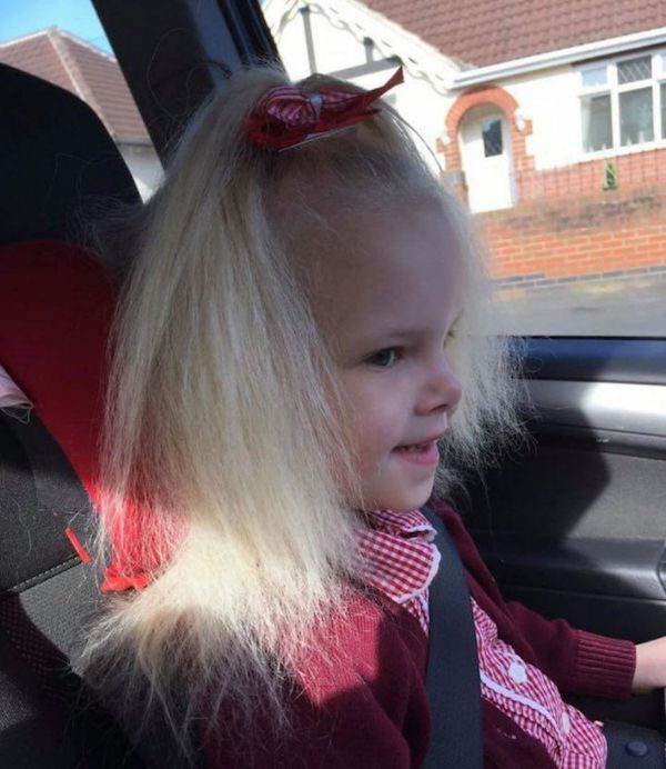 Mắc hội chứng hiếm gặp, bé gái người Anh sở hữu mái tóc y hệt thiên tài Vật lý Einstein - Ảnh 3.