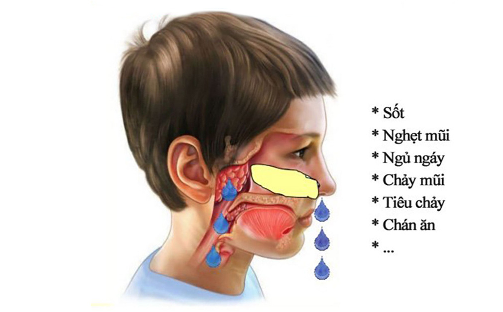 Sự thật về nạo VA gây suy giảm miễn dịch cho trẻ: Chuyên gia nói gì?