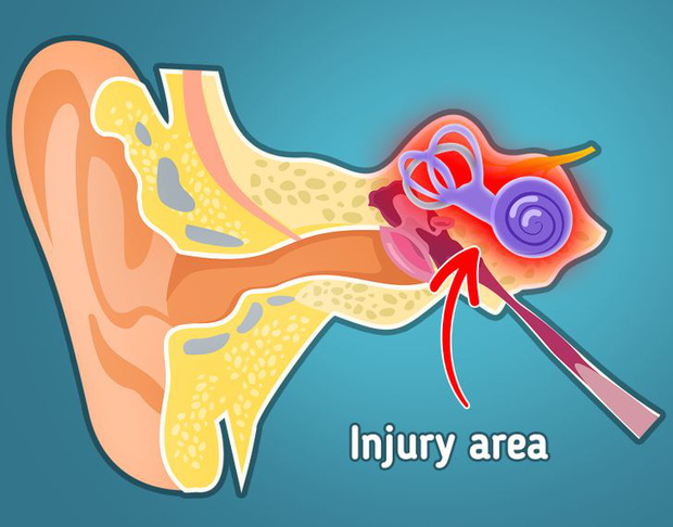 Chúng ta thỉnh thoảng lại nghe thấy âm thanh ù ù kỳ lạ trong tai: Lý do đằng sau là gì? - Ảnh 2.