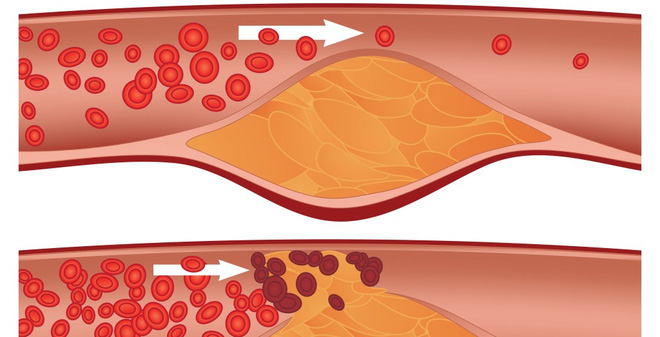 3 thực phẩm có thể quét sạch rác trong mạch máu: Vừa rẻ vừa tốt cho người bệnh huyết áp - Ảnh 1.