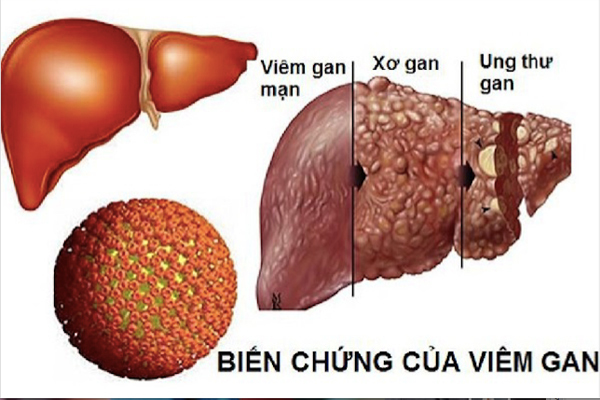 Người bệnh viêm gan B mạn tính nên ăn uống thế nào để phòng ngừa biến chứng? - Ảnh 2.