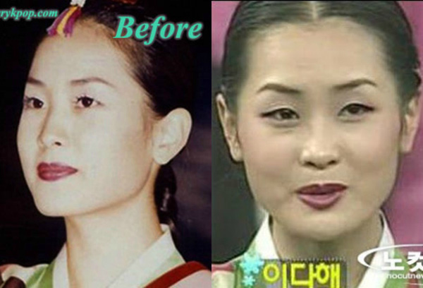 Muốn kiểm chứng thế nào là dao kéo thành công bậc nhất, nhất định phải xem màn lột xác như đổi đầu của dàn mỹ nhân Hàn này - Ảnh 12.