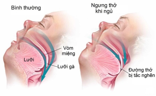 Nhóm người dễ mắc hội chứng ngừng thở khi ngủ và những biến chứng nguy hiểm - Ảnh 2.