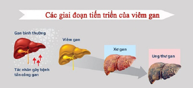 Khám định kỳ vẫn không phát hiện sớm ung thư gan, vì sao? - Ảnh 1.