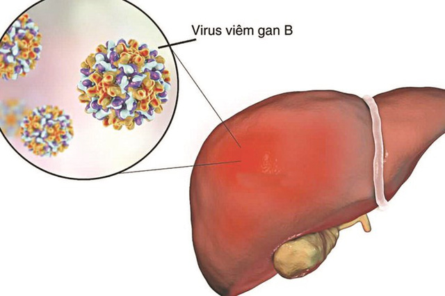 Khám định kỳ vẫn không phát hiện sớm ung thư gan, vì sao? - Ảnh 2.